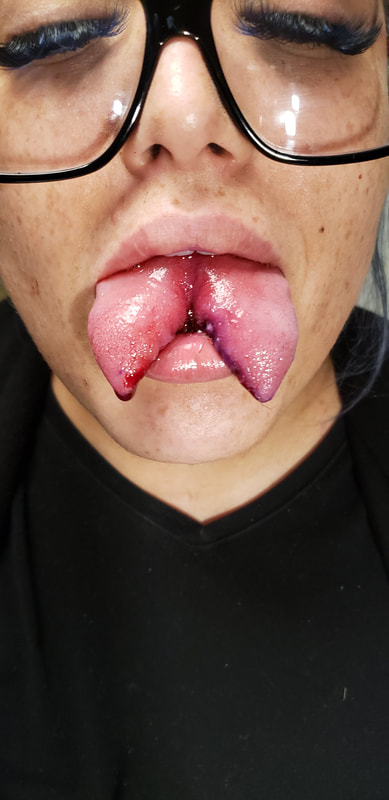 Tongue Bifurcation, Tongue Splitting, Tongue Split, Body Modification, Ottawa Ontario.